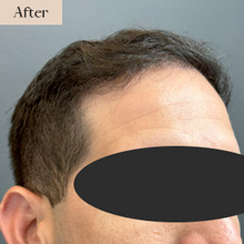 fue hair transplant white plains after treatment image